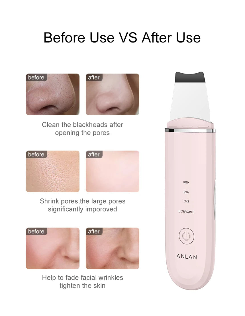 SkinRenew Ultrasonic Face Lifter – Deep Cleansing & Skin Tightening Device
